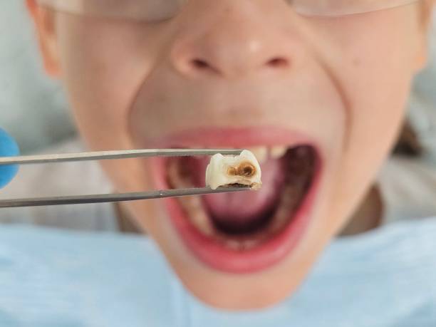 Best Emergency Dentist for Knocked-Out Tooth in Warsaw, NC